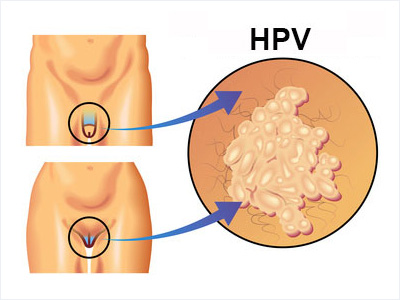 HPV Aşısı İzmir